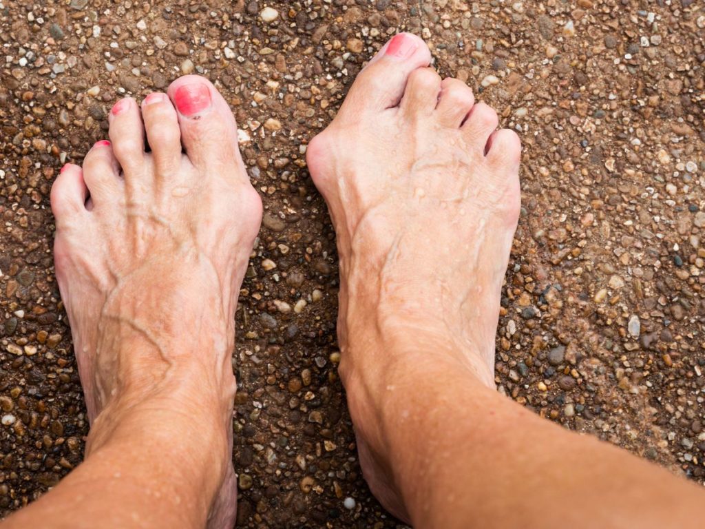 foot bunion deformity