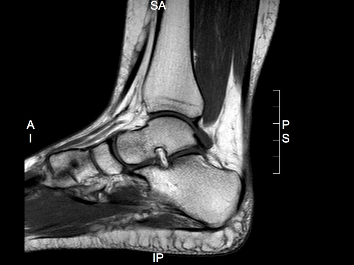When to Refer for MRI in Foot and Ankle Conditions